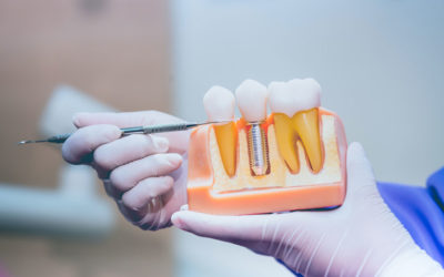 Come sostituire i denti mancanti? Dal dente singolo all’intera arcata, protesi fissa tradizionale e protesi fissa su impianti